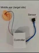 KGMU and IIT Kanpur Develop Ear Device for Anxiety and Panic Attacks