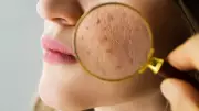 Laser Treatments for Seasonal Pigmentation: Expert Guide to Dark Spots and Uneven Tone