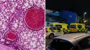 Meningitis Outbreak in UK Schools After Teen Dies, Two Sick