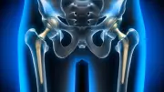 Minimally Invasive Hip Replacement Restores Mobility in Hours for Ankylosing Spondylitis Patient