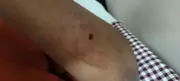 Nagpur Census Worker, Driver, Resident Bitten by Dog in Sadar