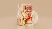 Recurrent Hernia: Causes, Surgery Failure, and Robotic Repair Success