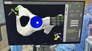 Robotic Hip Surgery Gives New Lease of Life to Morbidly Obese Man