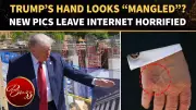 Trump’s Bruised Hand Photos Spark Health Rumors Ahead of Medical Exam