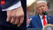 White House Reveals Reason for Trump's Hand Bruises: Handshakes and Aspirin