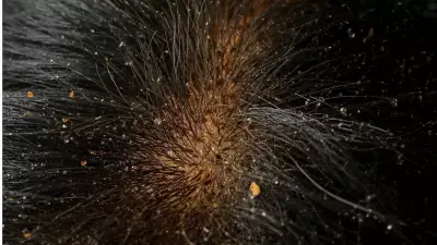 Dandruff Is Not a Hair Problem But a Scalp Issue: Here's What Science Says
