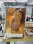 1952 Murder Solved Without DNA: Half Head Preserved in Chennai Museum
