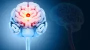 Brain Tumour Symptoms Often Mistaken for Stress or Migraines: Expert