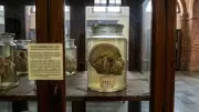 Madras Medical College Museum Holds Murder Victim's Head from 1952 Case