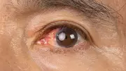 Protect Your Eyes from UV Rays: Expert Tips on Preventing Photokeratitis