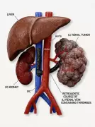 RMLIMS Doctors Perform Rare Robotic Surgery for Complex Kidney Cancer