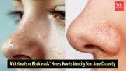 Whiteheads vs Blackheads: Key Differences and Effective Treatments