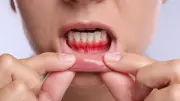 Why Your Gums Bleed While Brushing: Hidden Health Signals