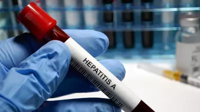 Hepatitis A and E Cases Rise in Mangaluru, Surveillance Ongoing