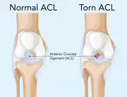 DoctorSpeak: All About Knee Injuries – Causes, Symptoms, and Recovery