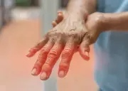 Stiffness in Fingers May Signal Rheumatoid Arthritis: Expert